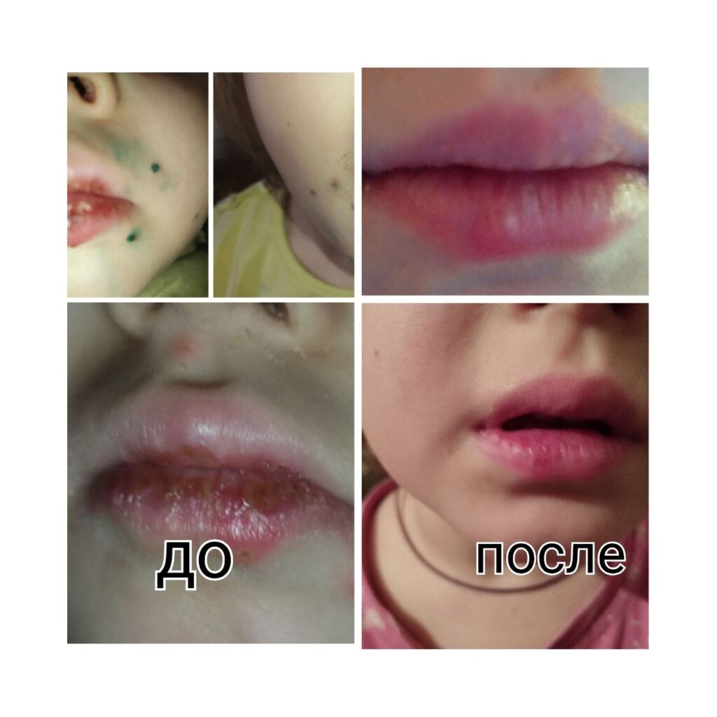 Опыт применения продукции Аврора: герпес и белая температура у детей