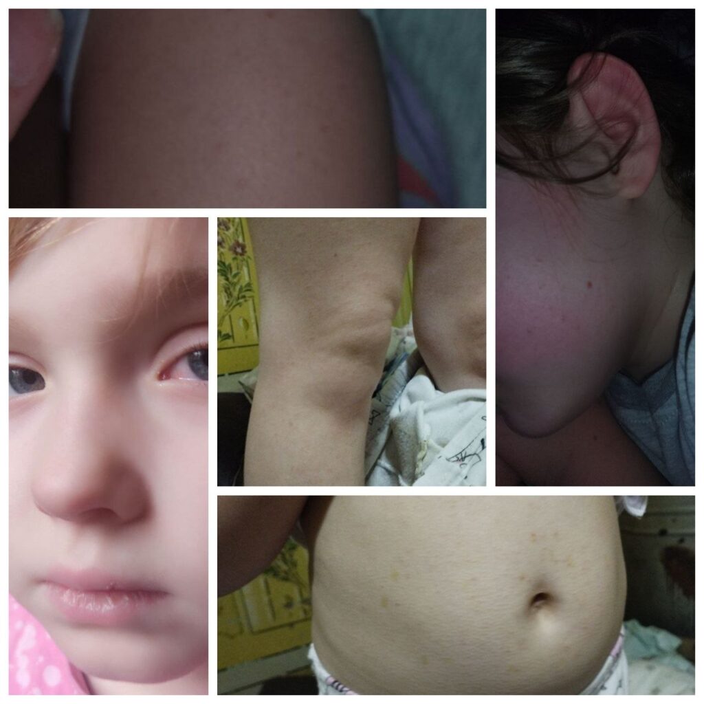 Очищение организма у детей: взгляд на сыпь, кашель и опыт с продукцией «Аврора»